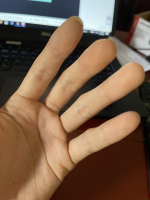 Cứng khớp buổi sáng trong viêm khớp dạng thấp